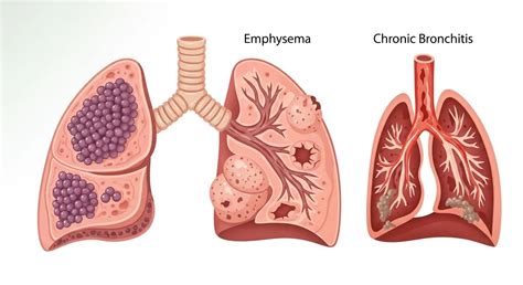 Key Differences Mesothelioma Vs Emphysema