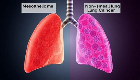 Key Differences Mesothelioma Vs Nsclc