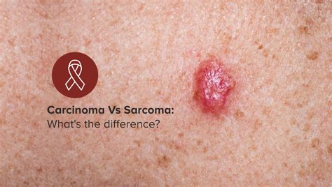 Key Distinctions Mesothelioma Vs Sarcoma
