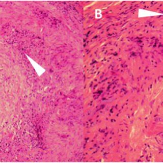Key Histopathological Features