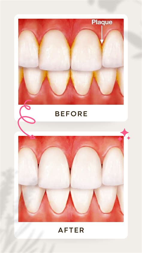Key Steps for Effective Plaque Removal Through Brushing