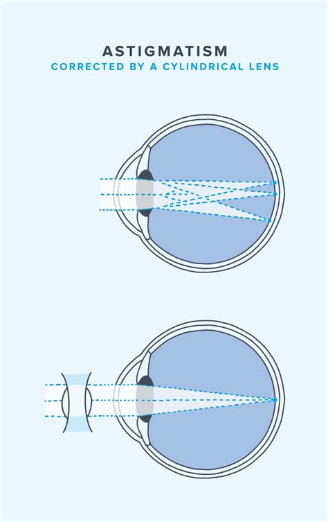 Key Steps in Correcting Astigmatism with LASIK