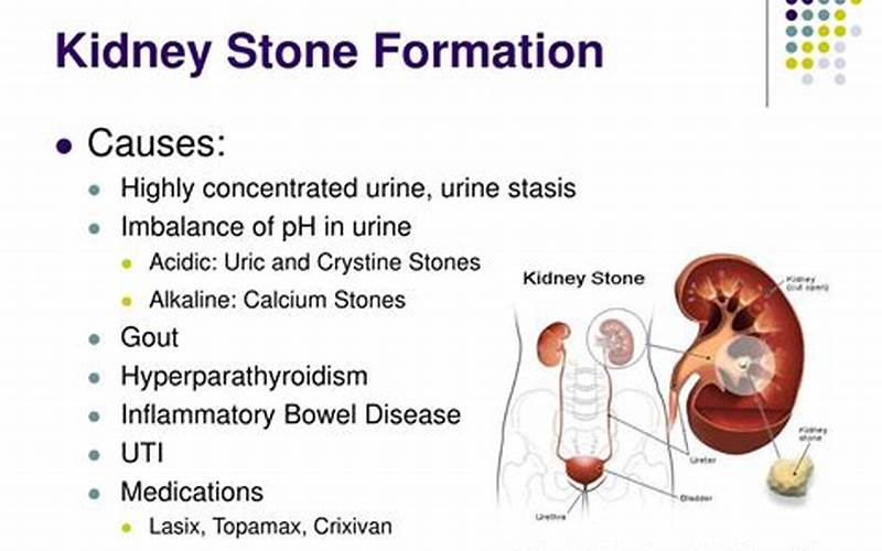 Kidney Stone Formation