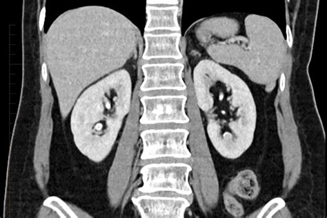 Kidney CT