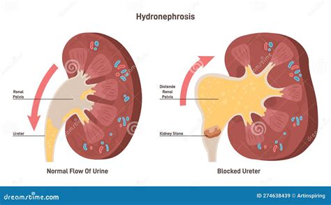 Kidney Damage (Hydronephrosis)
