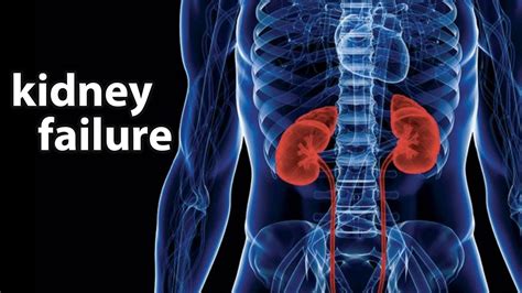 Kidney Failure & Nephrotic Syndrome: What You Need to Know.