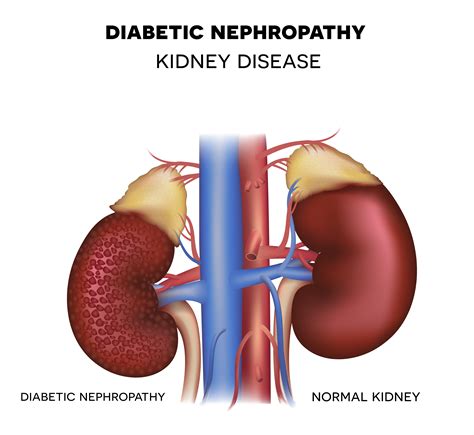 Kidney Failure Diabetic Nephropathy