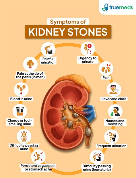 Kidney Stone Symptoms