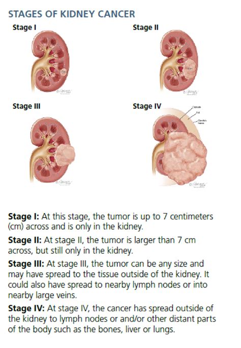 Kidney Tumor Size Chart