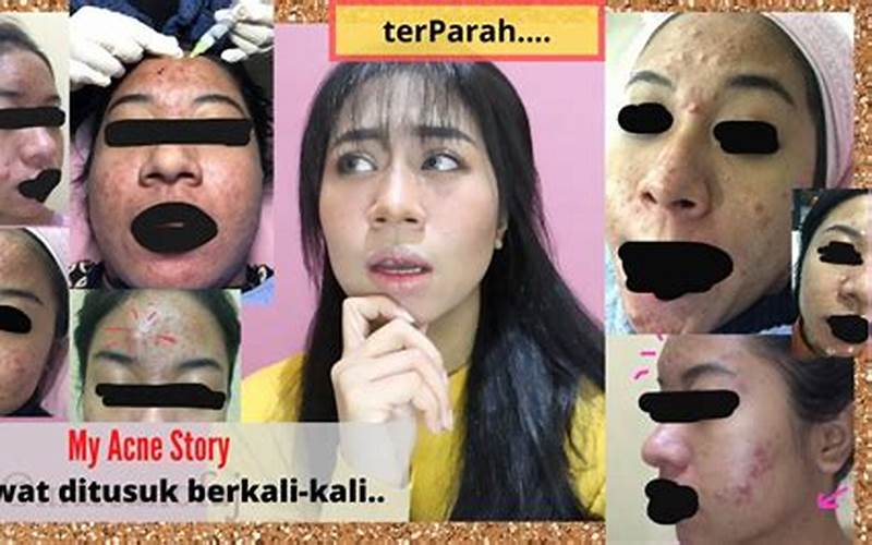 Kisah Jerawat Terparah Di Indonesia