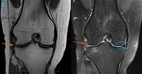 Knee Injury MRI