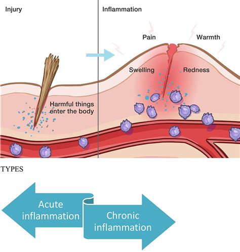 L'inflammation
