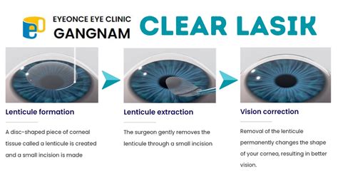 LASIK: Clear Vision, Reduced Risks Explained.