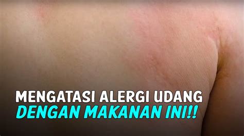 Langkah-langkah mengatasi alergi udang