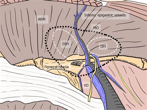 The laparoscopic view of inguinal anatomy. Download