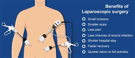 Laparoscopy: Minimally Invasive Surgery Explained.