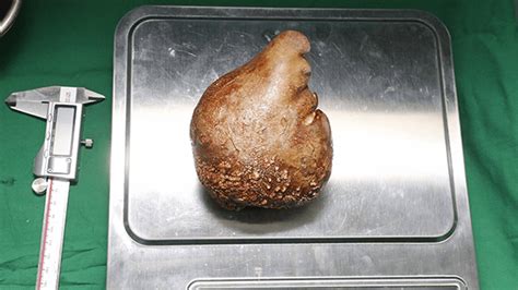 Largest Kidney Stone