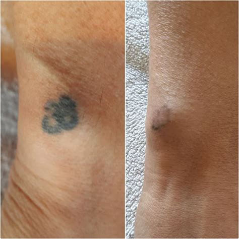 Tattoo Removal Auckland Cosmetic & Laser Clinics