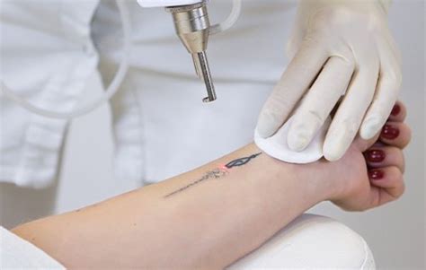 Laser Tattoo Removal Belfast QTATO