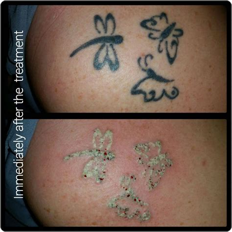 Laser Tattoo Removal Main Street Skin Clinic