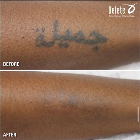MY LASER TATTOO REMOVAL RESULTS! Tattoo Removal on Dark