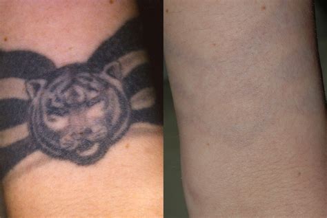 Before and After Laser Tattoo Removal Photos