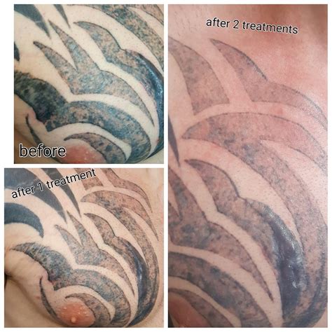 Tattoo Removal Before/After PicoSure Glasgow