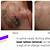Laser Tattoo Removal Itching