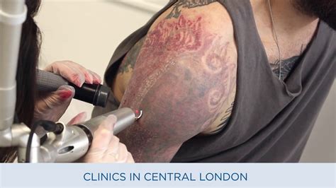 Live Laser Tattoo Removal 1st Session on inner wrist at