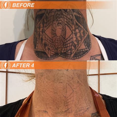 Laser Tattoo Removal Melbourne Fresh Skin Canvas Call