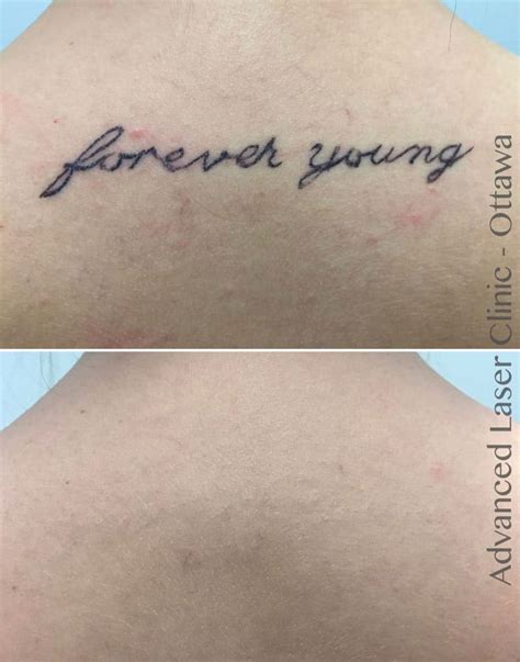 Laser Tattoo Removal Ottawa Dermis Advanced Skin Care Ottawa