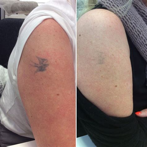 Susan's Orlando Life Picosure Laser Tattoo Removal Review!!!