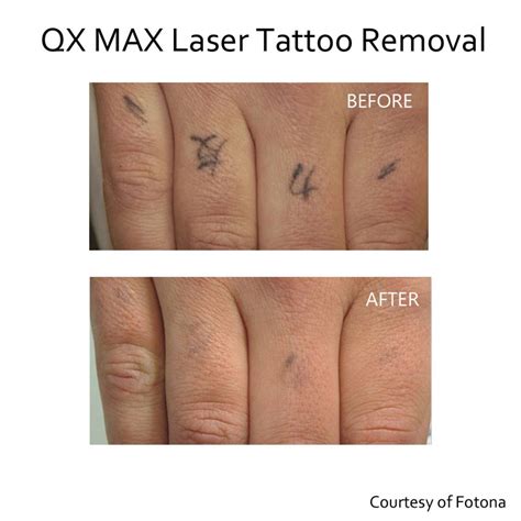 Tattoo Removal Dermatology and Laser Centre of Los Angeles