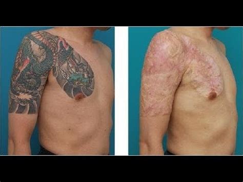 What To Expect After Laser Tattoo Removal / What to expect
