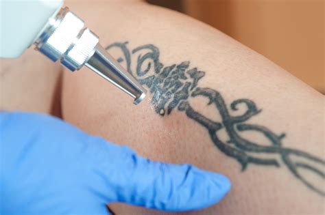 Erasing the past Tattoo removal event helps remove