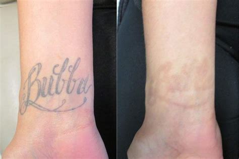 Tattoo Removal Before And After Photos At Disappearing Inc