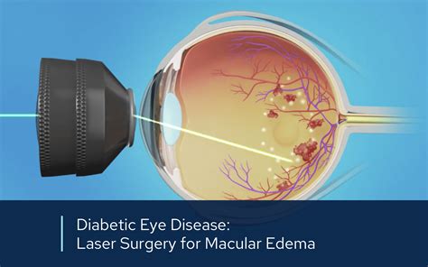 Laser surgery for Diabetic Retinopathy