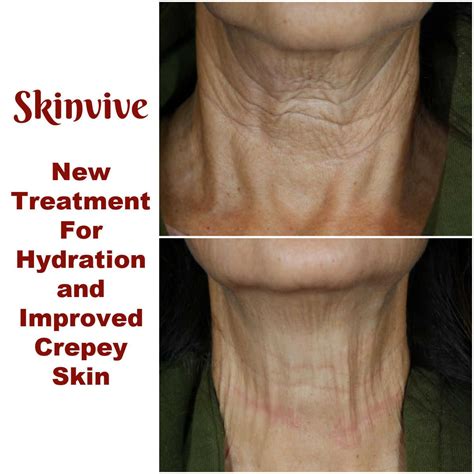 Banish Crepey Skin with Laser Technology: Your Ultimate Solution