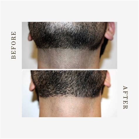 Laser Hair Removal Beard