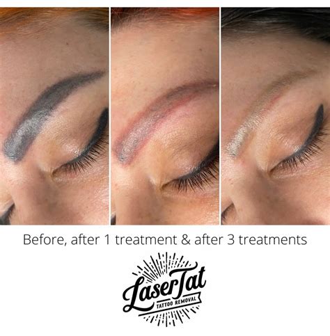 Laser Removal For Eyebrow Tattoo