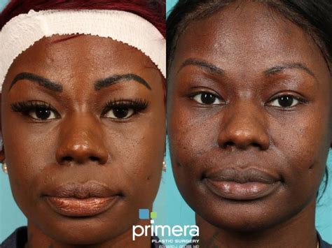 Reveal Radiant Skin: Unlock the Secrets to Effective Laser Resurfacing for Dark Skin tones