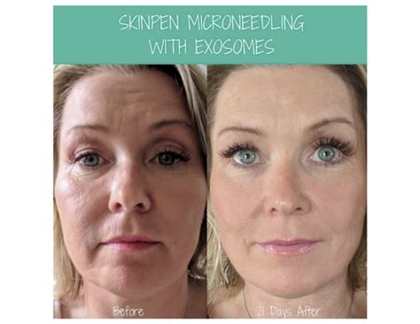 Transform Your Skin with Laser Rejuvenation in Chicago: Unleash a New You!