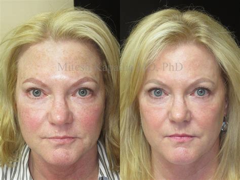 Discover the Secret to Flawless Skin with Laser Skin Resurfacing in Boston!