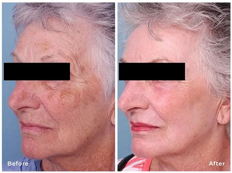 Renew Your Skin's Radiance with Top-Notch Laser Skin Resurfacing in Philadelphia