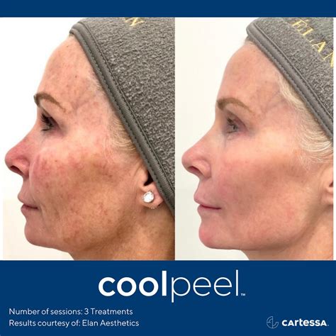 Unlock the Secret to Radiant Skin: Discover the Transformative Power of Laser Skin Resurfacing in Pittsburgh