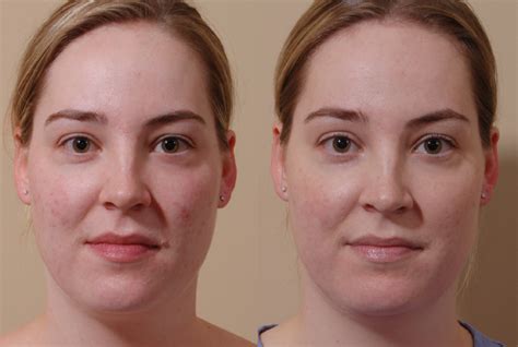 Luminous Skin Awaits: Experience the Magic of Laser Skin Resurfacing in Seattle