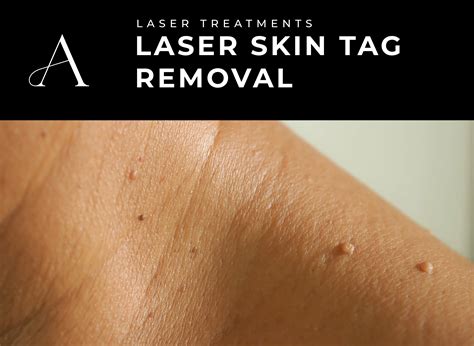 Transform Your Skin: Laser Skin Tag Removal Before and After