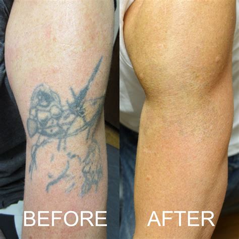 Laser Tattoo Before And After