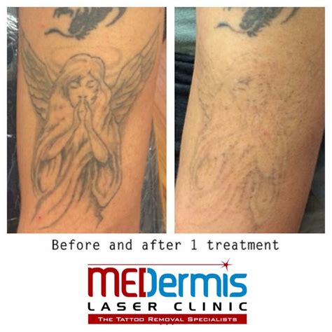 Before & After Tattoo Removal After One Session