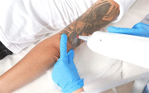 Laser Tattoo Removal Aftercare Cream My Tattoo's